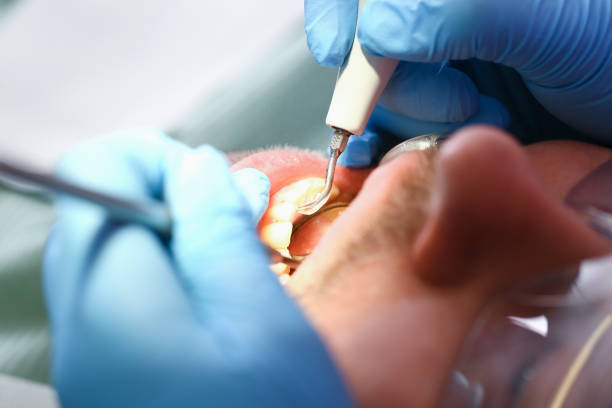 Best Emergency Dental Care for Sports Injuries in Avon Lake, OH